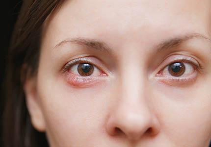 “Illustration of blepharitis symptoms caused by poor eyelid hygiene”